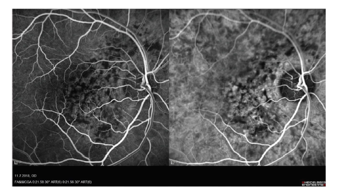 Snímek fluorescenční angiografie a angiografie s indocyaninovou zelení hemangiomu
cévnatky