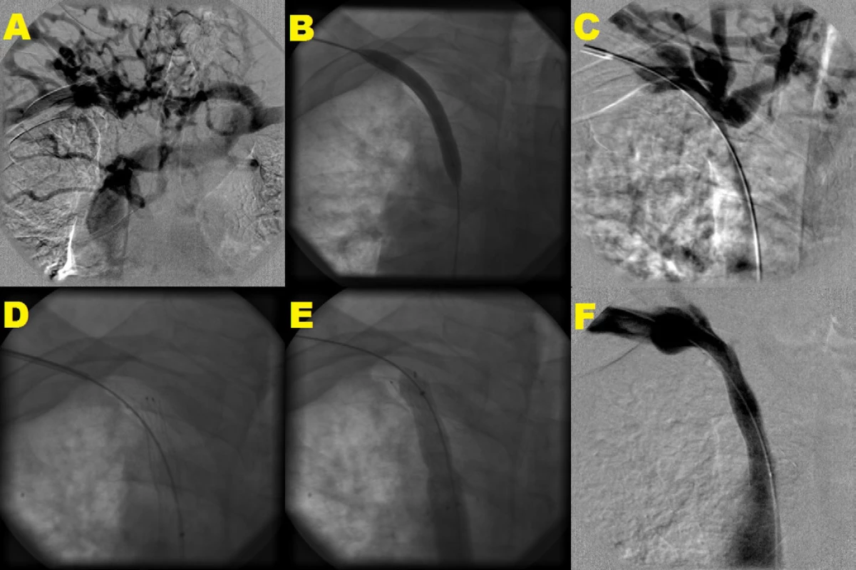 Angioplastika a stenting v. brachiocephalica vpravo<br>
 Angiografia centrálnych žíl s tesnou stenózou v. brachiocephalica vpravo, kolaterálne plnenie cestou v. brachiocephalica vľavo a v. cava superior. Angioplastika s 10 mm balónikom s nedostatočným efektom (B, C) s následnou implantáciou samoexpandovateľného stentu 14 × 40 mm s jeho dodilatáciou pomocou 12 mm balónika (D, E). Kontrolná angiografia s konečným výsledkom bez reziduálnej stenózy, bez plnenia kolaterál (F)
