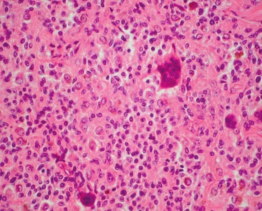 Nádor obsahoval obrovské viacjadrové bunky. Histomorfologicky sa jedná
o obrovskobunkový nádor zo šľachových pošiev (hematoxylin-eozín, 400x).