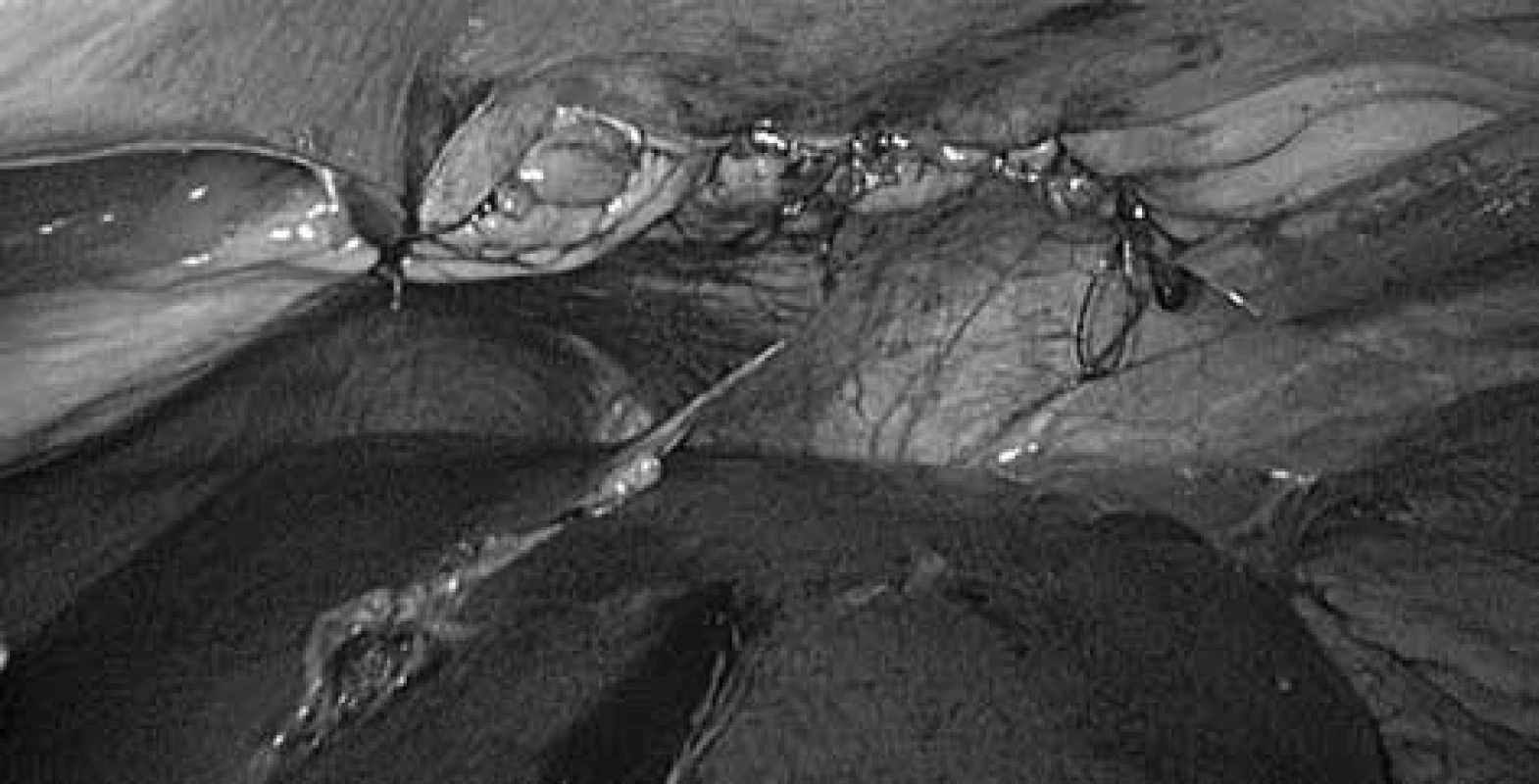  Sutura defektu bránice<br>
Fig. 6: Suture of the diaphragmatic defect
