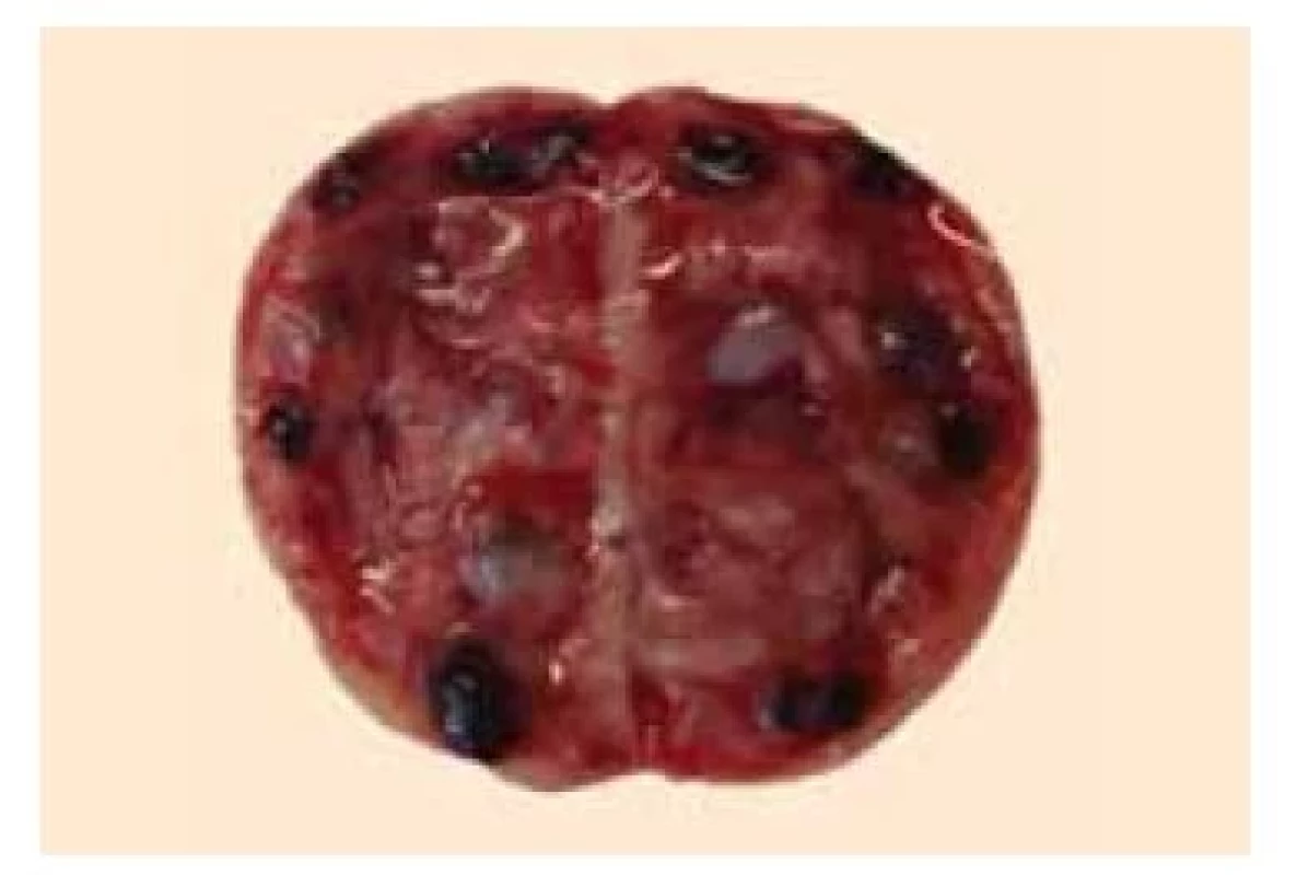 Rozpůlené ovarium s antrálními
folikuly v medule.<br>
Fig. 4. Bisected ovary with antral follicles
in the medulla.