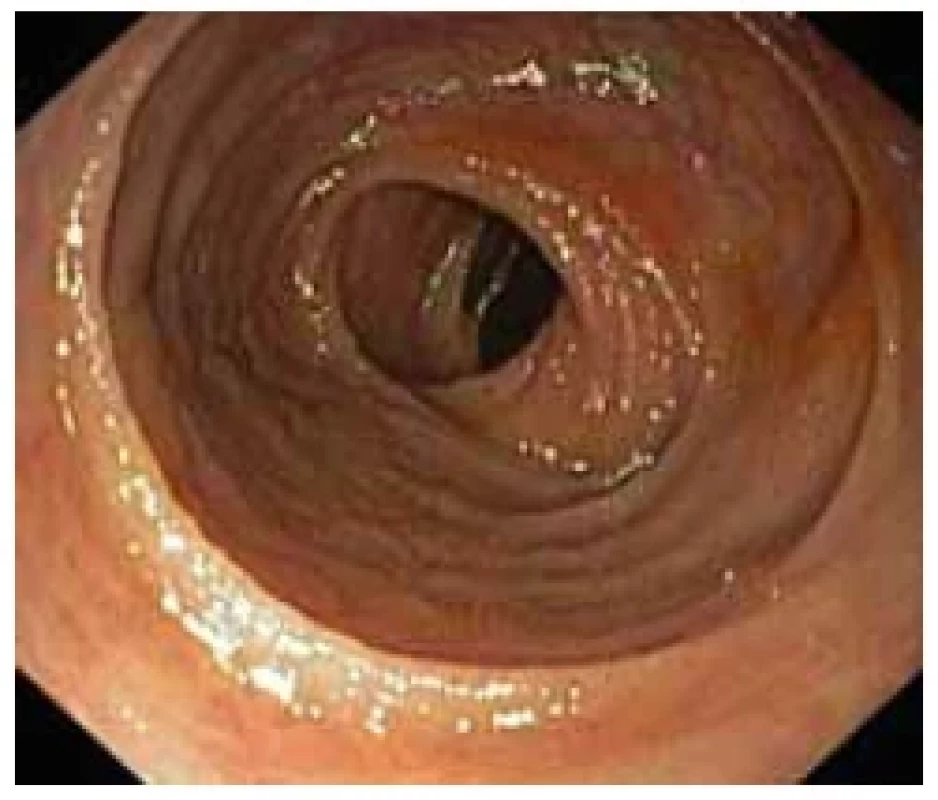Klidová fáze ulcerózní kolitidy
s granulovanou sliznicí a nepřítomností
cévní kresby – Mayo endoskopické subskóre
1. <br> 
Fig. 2. Resting phase of ulcerative colitis
with mucosal granularity and absence of
vascular pattern – Mayo endoscopic subscore
1.