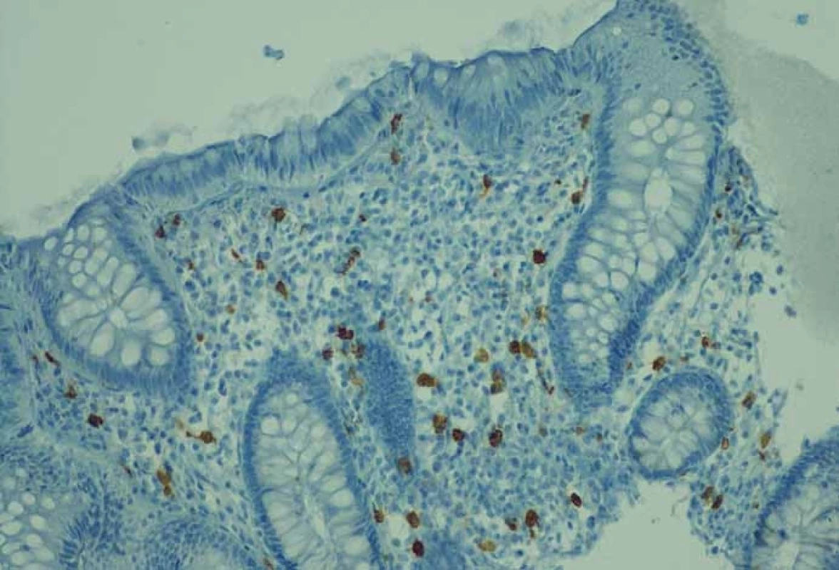 Imunohistochemický průkaz mastocytů protilátkou CD 117 (klon Y145, Biocare, zvětšení 20×).<br>
Fig. 2. CD 117 immunohistochemical staining of mast cells (clone Y145, Biocare, enlargement 20×).