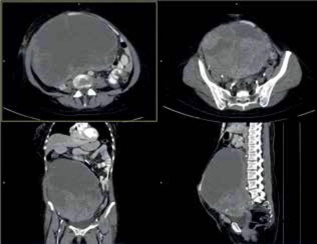 CTA obraz tumoru<br>
Fig. 8: CTA scan of the tumor