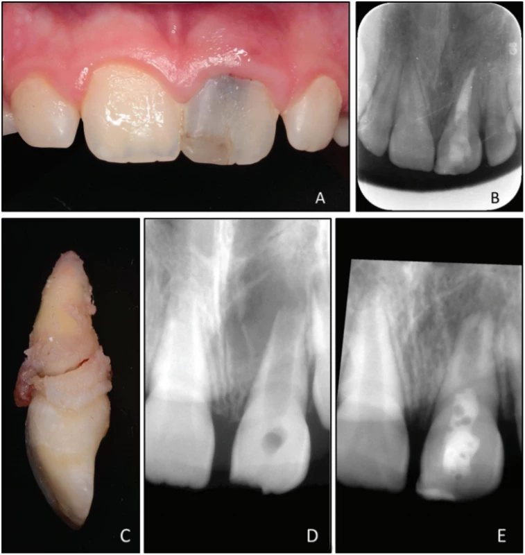 A Fotografie klinického stavu
21 měsíců po dokončení
endodontického ošetření
zubu 21; je přítomna šedavá
dyskolorace klinické korunky;
B intraorální rentgenový
snímek v apikálním zastavení
21 měsíců po endodontickém
ošetření;
C extrahovaný zub
21 s horizontální frakturou
kořene;
D upravený diagnostický
rentgenový snímek zubu
21 před ošetřením
maturogenezí;
E upravený intraorální
rentgenový snímek zubu
21 před endodontickým
ošetřením<br>
Fig. 1
A Clinical photograph taken
during follow-up 21 month
after root canal treatment;
grayish discoloration of tooth
21 is clearly visible;
B intraoral radiograph taken
during follow-up 21 month
after root canal treatment;
C extracted tooth 21 with
oblique fracture,
D aligned preoperative
intraoral radiograph
of tooth 21;
E aligned postoperative
intraoral radiograph of tooth
21 before root canal treatment