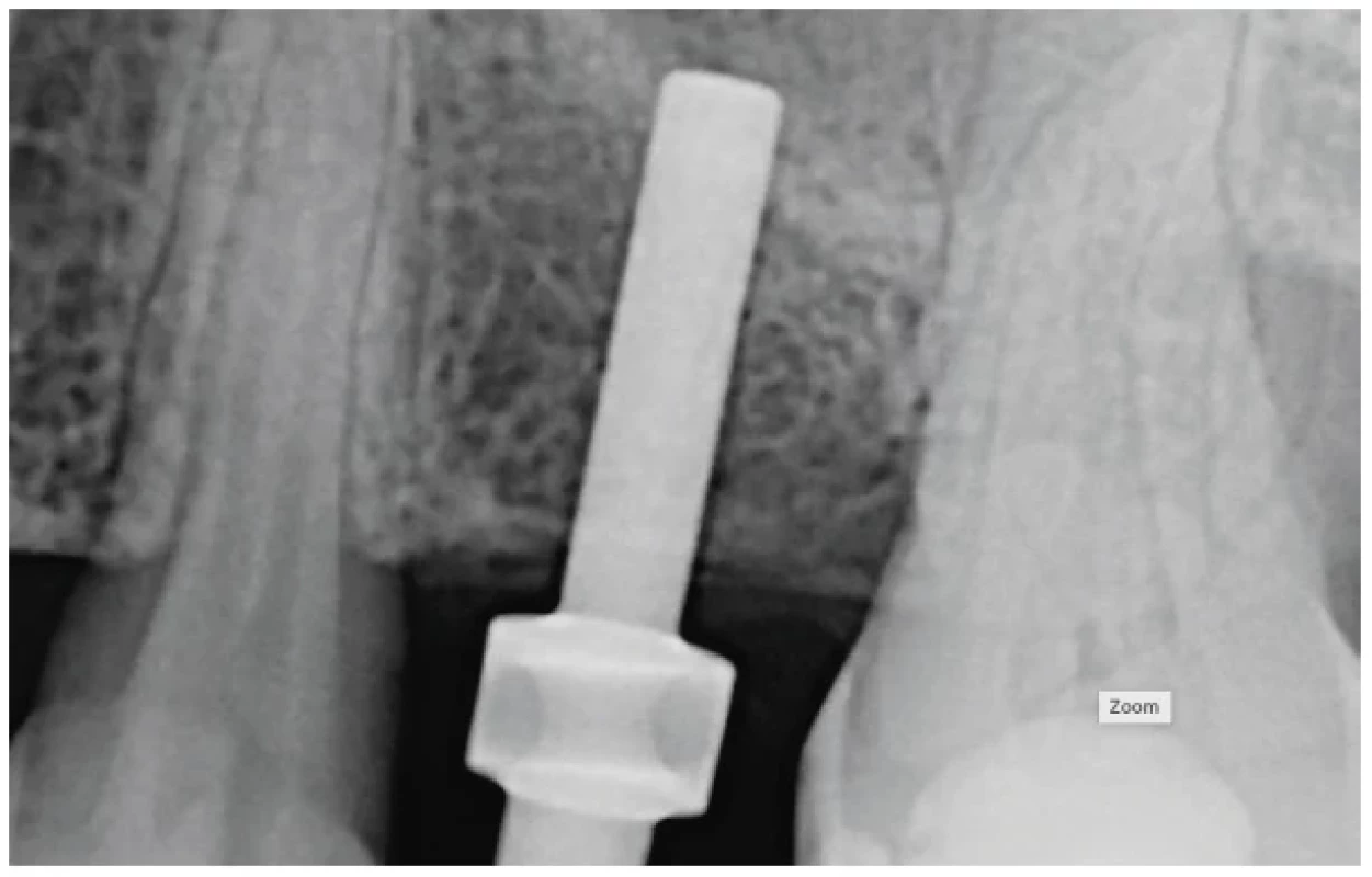 RTG snímek svažujícího se
dna alveolárního recesu
před zavedením implantátu
a provedením sinus liftu bez
alograftu <br> 
Fig. 4 Radiographic immage of the
slanted alveolar recess of the
maxillary sinus priror to sinus
lift without allograft