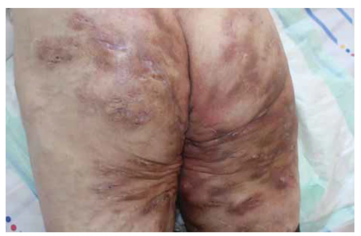 Pacient s hidradenitis suppurativa v gluteálnej časti Hurley III, s potvrdenou
Crohnovou chorobou.<br>
Fig. 3. Patient with hidradenitis suppurativa in gluteal region (Hurley III) with confirmed 
Crohnʼs disease.