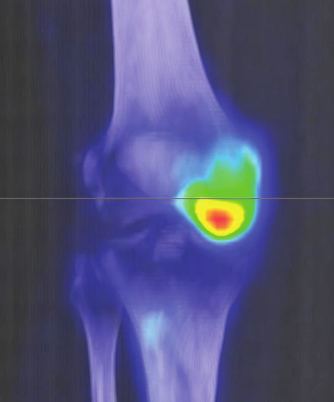 Sumarizace nálezů <sup>18</sup>F-FDG PET/CT vyšetření u pacienta č. 4. Černobílé MIP
projekce ukazují rozsah snímání, odráží i rozsah kostního postižení. Fúzované obrazy
pak ukazují detaily kardiovaskulárního, retroperitoneálního, paranasálního, orbitálního
i kostního postižení.