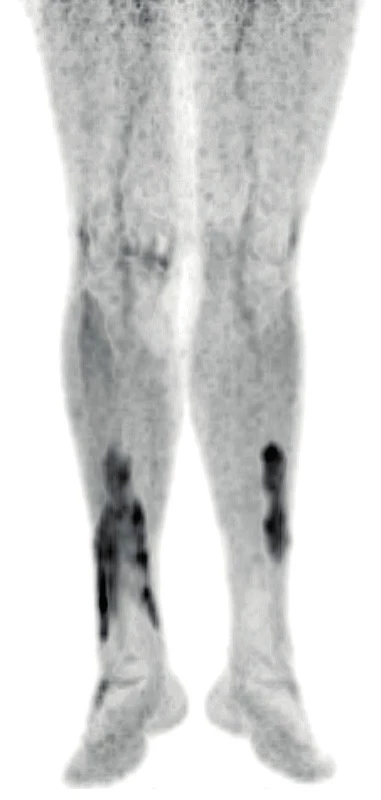 PET/CT zobrazení dolních končetin pacienta s xantogranulomem
z roku 2019 – část 1