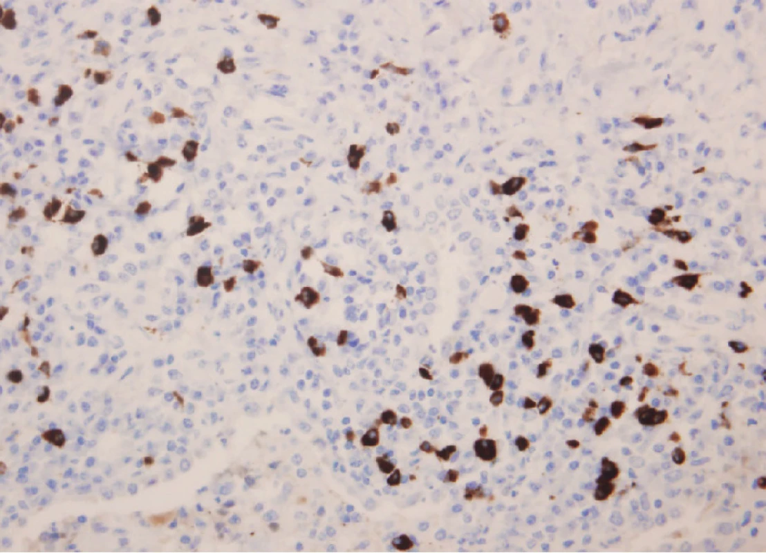 Imunohistochemický nález u pacienta s IgG4 asociovaným plicním
onemocněním. Průkaz IgG4+ plazmocytu (400krát)