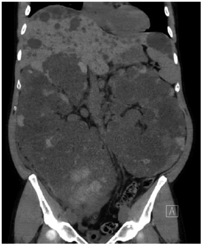 Stejná ledvina na předoperačním zobrazení MRI
(vpravo, zdroj: archiv autora) <br> 
Fig. 2. Same kidney on MRI before surgery (source:
author)