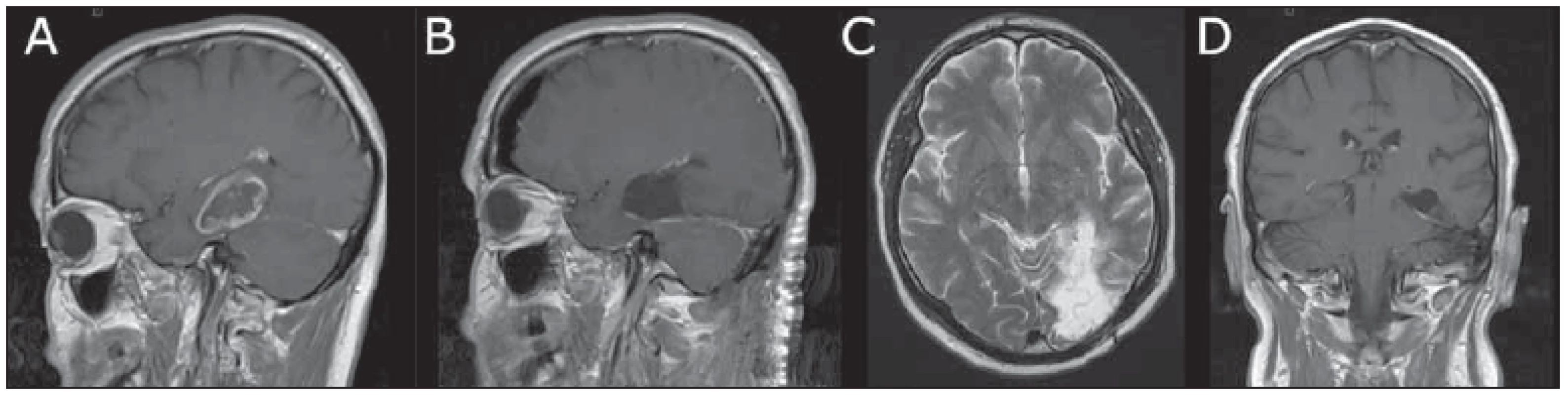 Transtentoriálně resekovaný glioblastoma multiforme hipokampu u 60letého pacienta. <br>
Fig. 1 Transtentorially-resected glioblastoma multiforme of the hippocampus in a 60-year-old male.