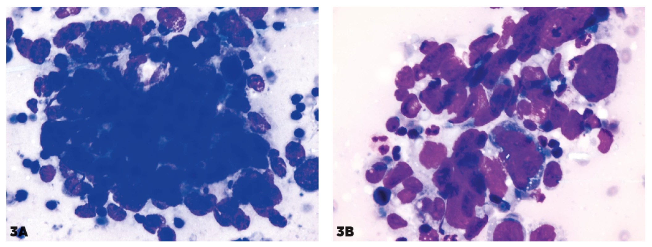 Kohezívne zhluky pri difúznom veľkobunkovom lymfóme<br>
B-pôvodu (DLBCL)<br>
3A, 3B – kohezívne zhluky pripomínajúce MTS<br>
