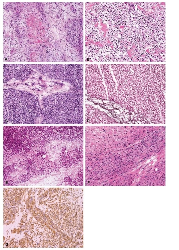(A) Metastáza dlaždicobuněčného karcinomu do proximálního
femuru, primární lokalizace: děložní čípek (HE, 200x).
(B) Konvenční high-grade osteosarkom, osteoblastická varianta
v proximální tibii u 57letého muže (HE, 200x). (C) Ewingův
sarkom malé pánve u 21letého muže, v době diagnózy 24 cm
v největším rozměru (HE, 200x). (D) Ewingův sarkom, barvení na
retikulin dle Gömöriho (200x). (E) Ewingův sarkom, cytologický
preparát – otisk (HE, 200x). (F) Leiomyosarkom grade 2 na ventrální
straně bérce u 48leté ženy (HE, 200x). (G) Leiomyosarkom,
desmin, (200x).