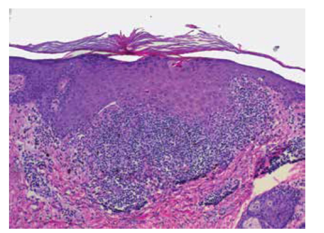 Histologie lichen planus (HE 100x)