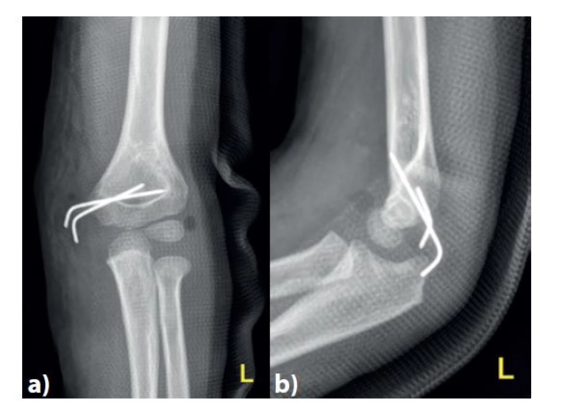 Kontrolní snímek po osteosyntéze dvěma divergentně
vedenými Kirschnerovými dráty v předozadní a)
a bočné b) projekci<br>
Fig. 5: Follow-up plain X-ray after osteosynthesis with two
Kirschner wires – anteroposterior a) and lateral b) views