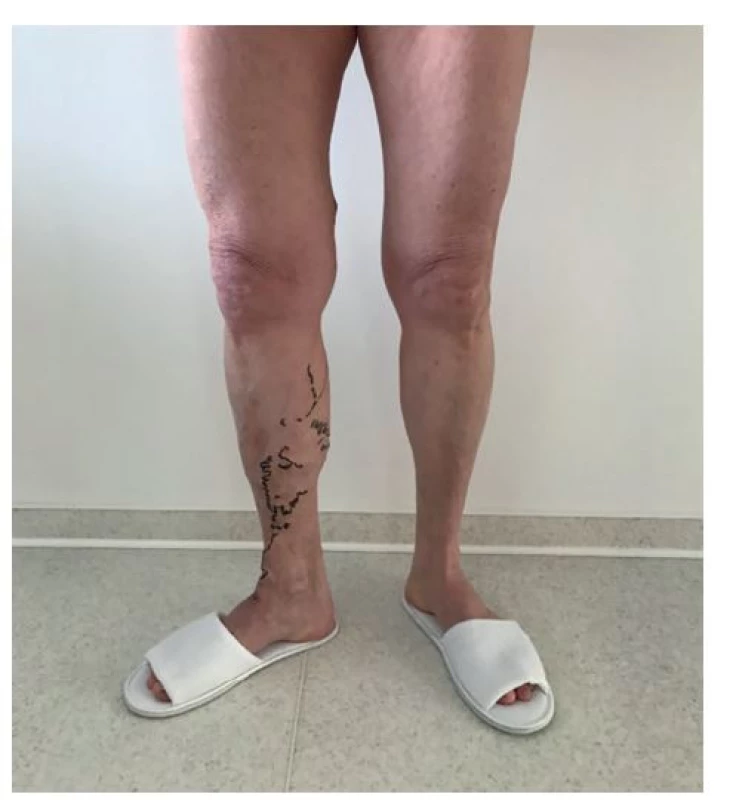 Insuficientní úseky žil vyznačené na kůži před operací<br>
Fig. 1: Insufficient vein sections marked on the skin before
surgery