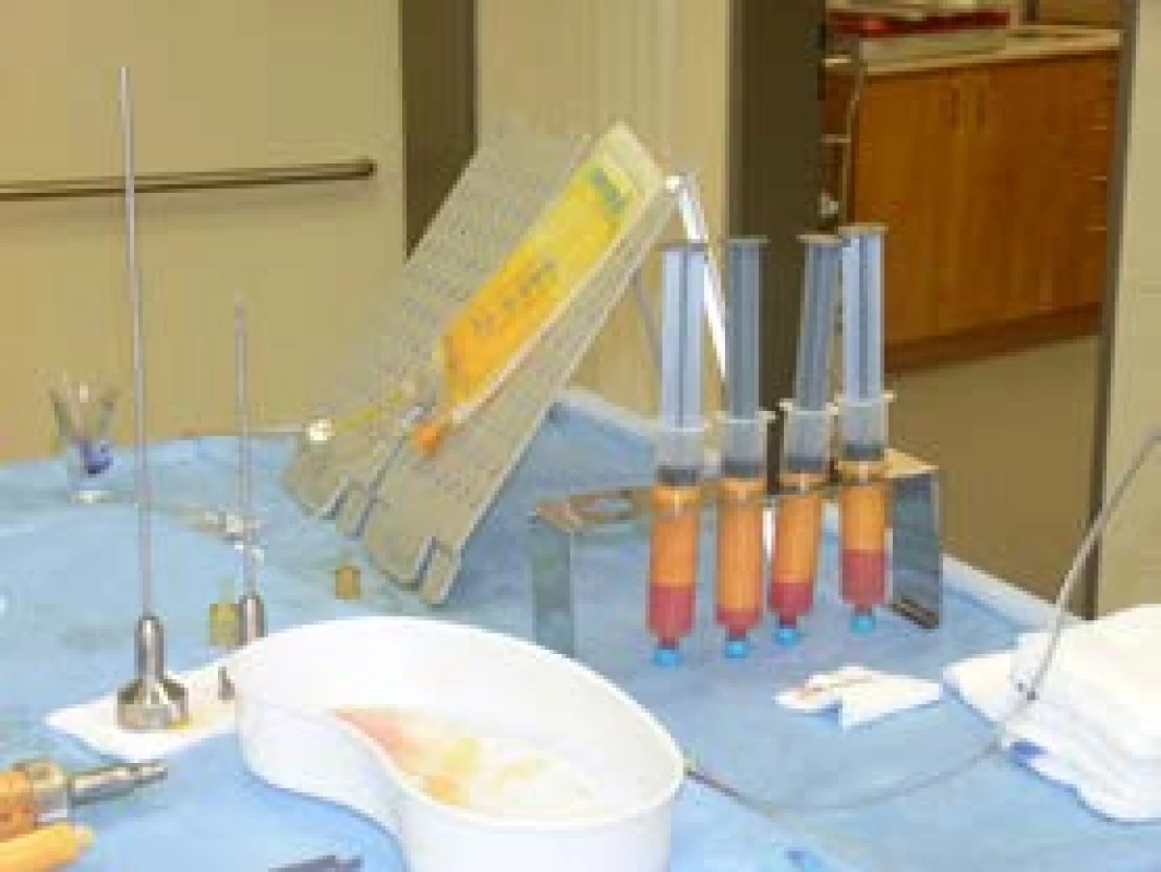 Macrofat graft, uzavřený filtrační systém