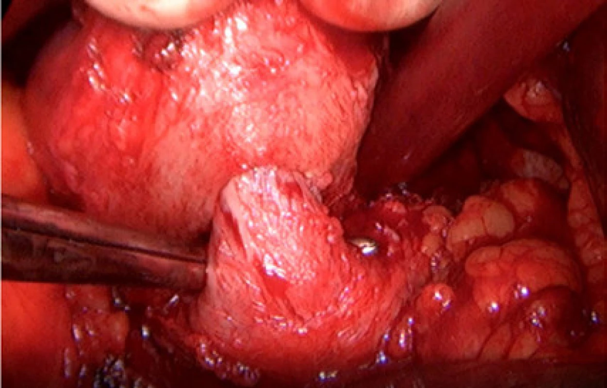 Prezervace hrdla močového měchýře otevřenou
operační technikou<br>
Fig. 1. Bladder neck preservation with open surgical
technique