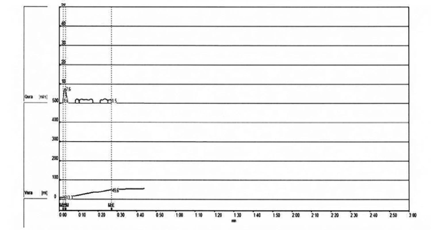 Uroflowmetrie – malý objem močení<br>
Fig. 1. Uroflowmetry – small volume of urine