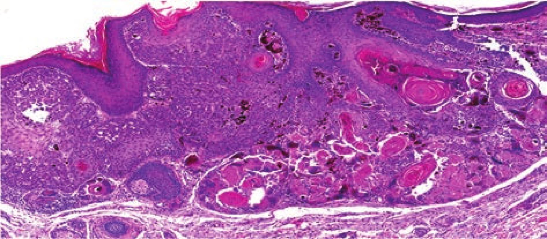 Čepy větších keratinocytů s  keratinizačními centry
vrůstající z epidermis do koria
