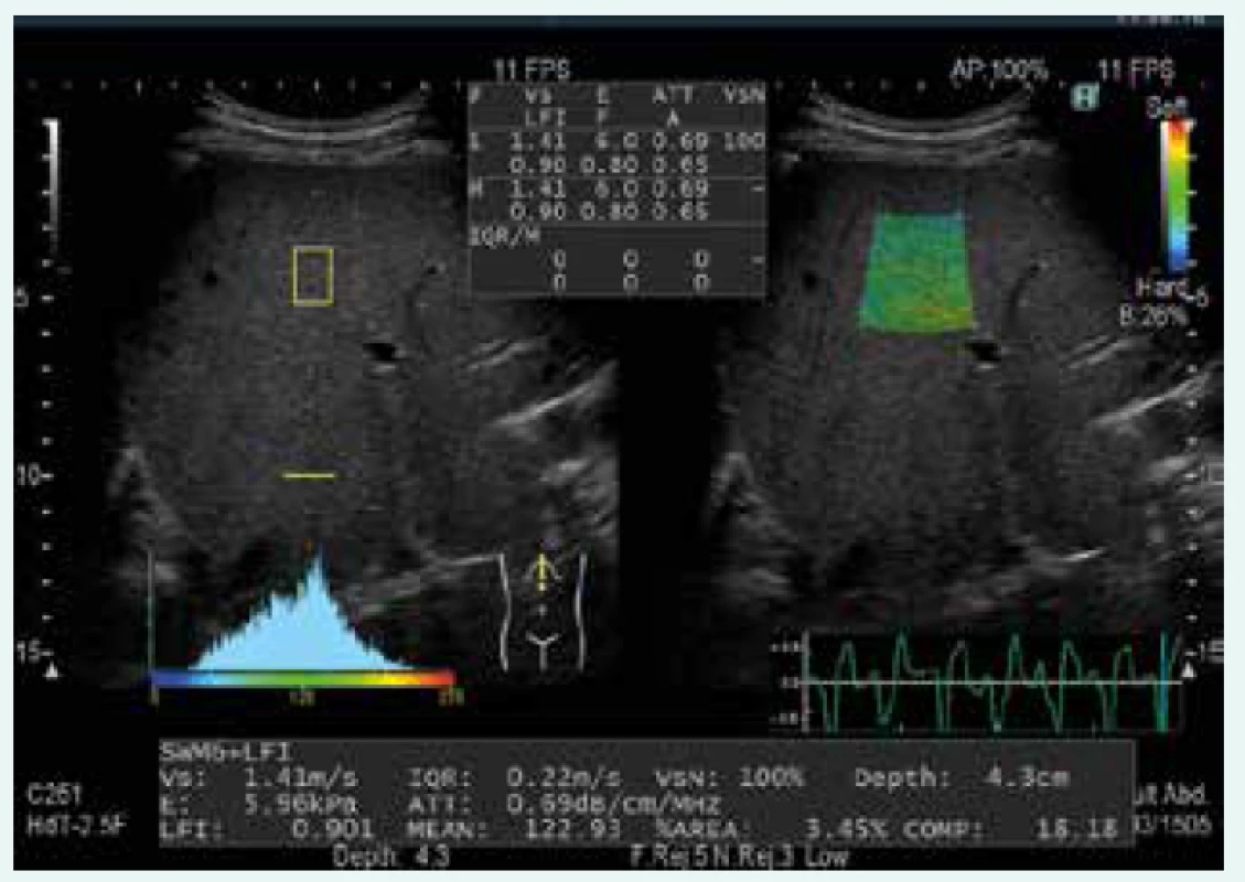 Kombinace pSWE, strain elastografie a ATT v jednom měření (přístroj Arietta 850, Hitachi-Aloka)
