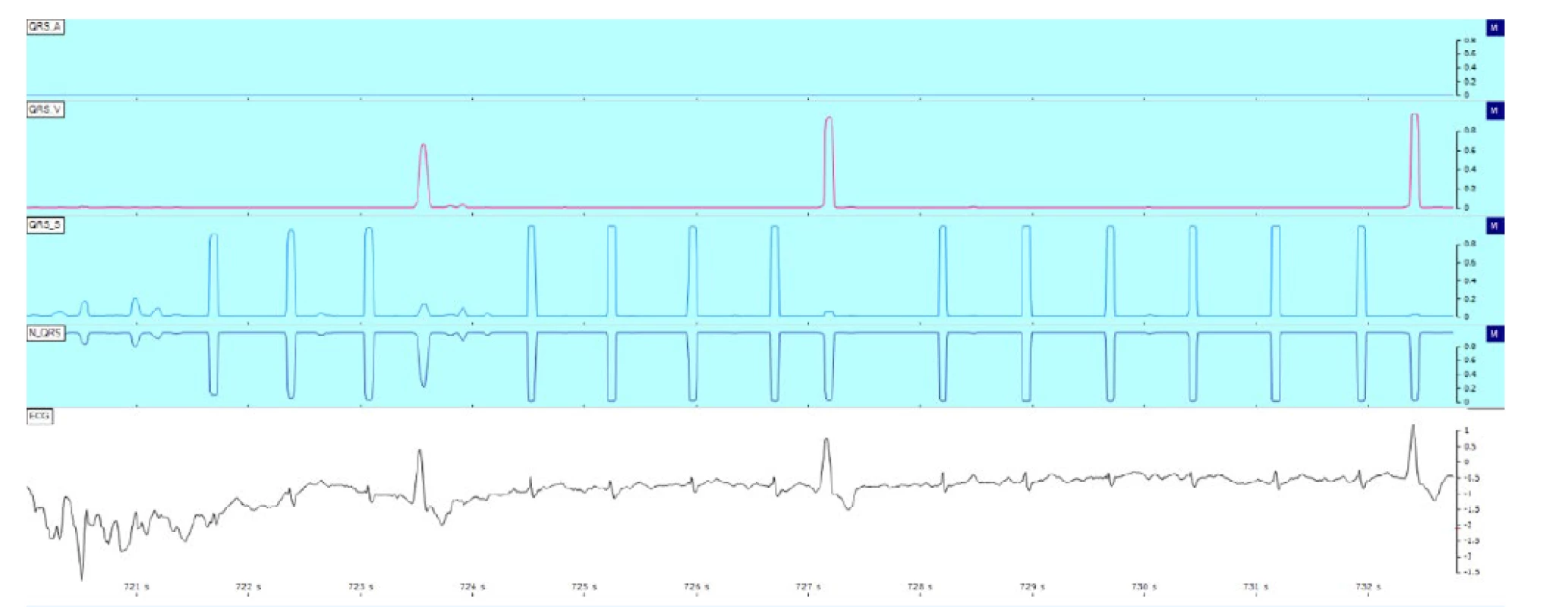 Hluboké učení a komplexy QRS.