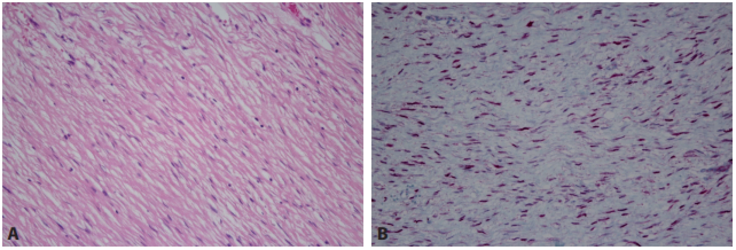 Intraabdominální fi bromatóza. Histologicky poměrně nenápadná proliferace paralelně uspořádaných vřetenitých buněk (A – HE, 200x),
které typicky vykazují aberantní jadernou expresi β-cateninu (B – 200x).