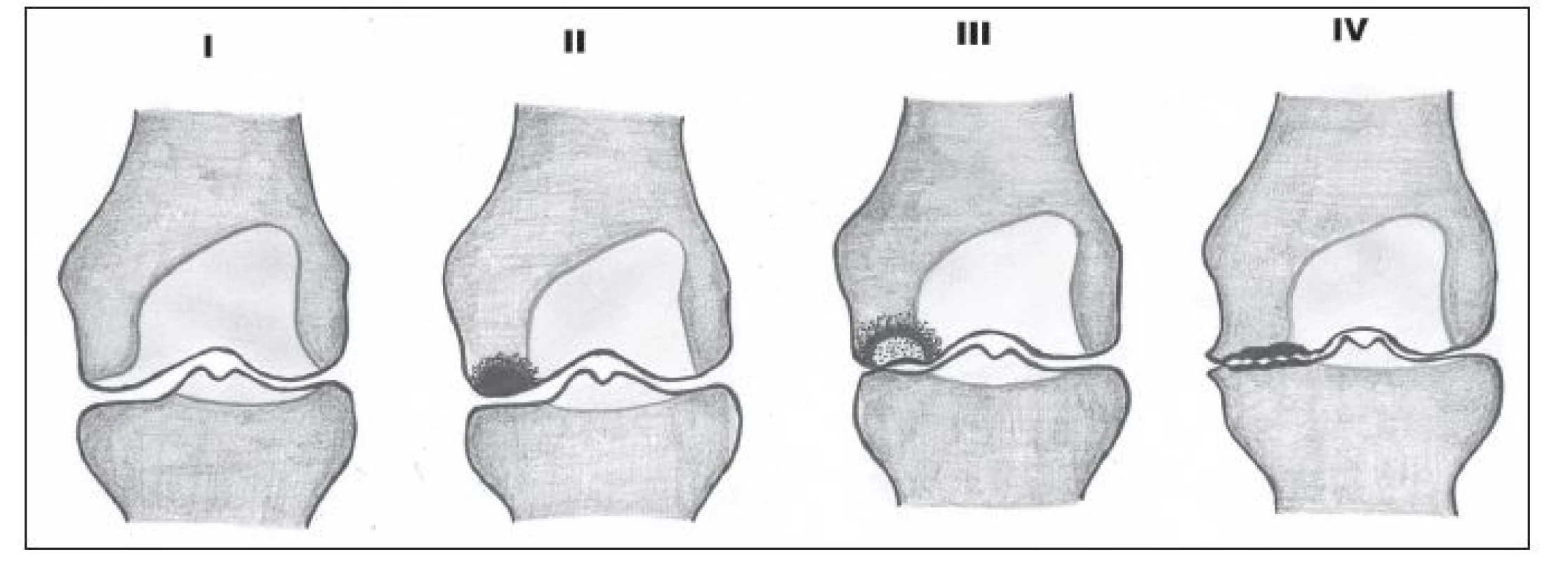 Spontánní osteonekróza – stádia I–IV. I – bez RTG a CT změn, scintigrafie pozitivní, II – sklerotické (nebo cystické)
změny, normální chrupavka, scintigrafie pozitivní, III – na CT a RTG subchondrální kolaps s projasněním, IV – degenerativní
změny.