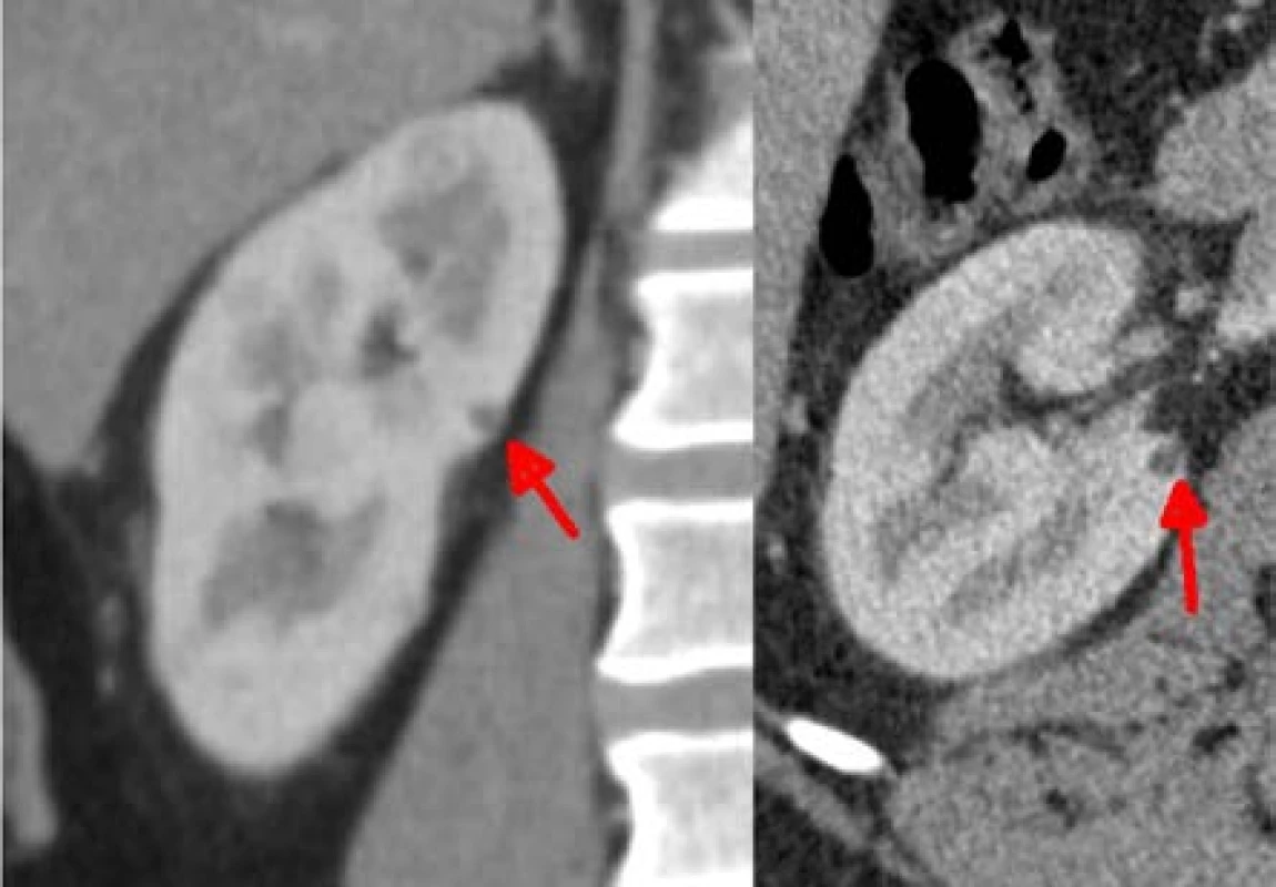 Nejmenší ložisko velikosti 5 mm, odstraněno
jako třetí, bez ischemie<br>
Fig. 3. The smallest lesion of 5 mm. It was removed
as the third one, without ischemia