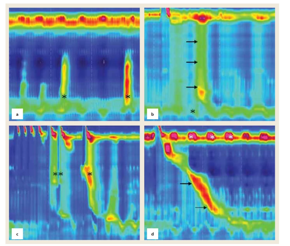 Poruchy motility u pacientov s PD. a) Simultánne (nepropulzívne) kontrakcie v distálnej polovici pažeráka (*).
b) Panezofágová presurizácia na 30-mmHg izobare; obraz typický pre achaláziu (→) pri normálnom relaxačnom tlaku
LES (*). c) Multiple rapid swallows s iniciáciou presurizácie, ktorá siaha od UES po strednú tretinu pažeráka (**),
následne sa iniciuje panezofágová presurizácia (*). d) Normálna propulzívna peristaltika (→), prítomný je však cyklický
hypertonus UES (*), dosahujúci maximálny tlak až 250 mmHg.<br>
Fig. 1. Motility disorders in patients with PD. a) Simultaneous (non-propagating) contractions in the distal esophagus (*).
b) Panesophageal pressurization on the 30-mmHg isobaric contour; typical for achalasia (→) , however, normal LES relaxation
pressure (*). c) Multiple rapid swallows with pressurization from the UES to the mid esophagus (**), followed by panesophageal
pressurization (*). d) Normal propagating peristalsis (→) and cyclic hyperrensive UES (*), with maximum pressure of
as much as 250 mmHg.