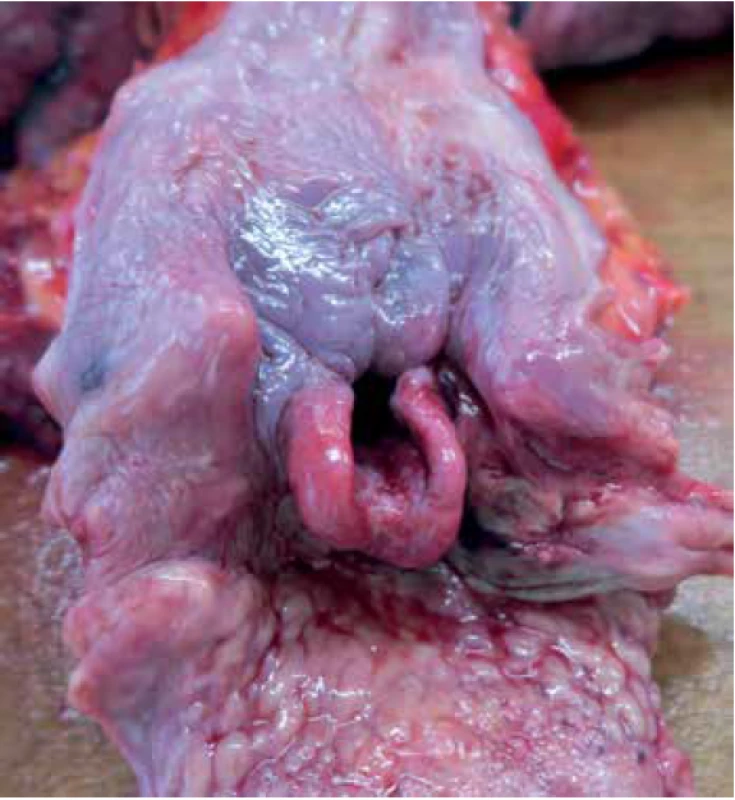 Massive oedema of the epiglottis and adjacent soft tissue (after cutting the oesophagus).