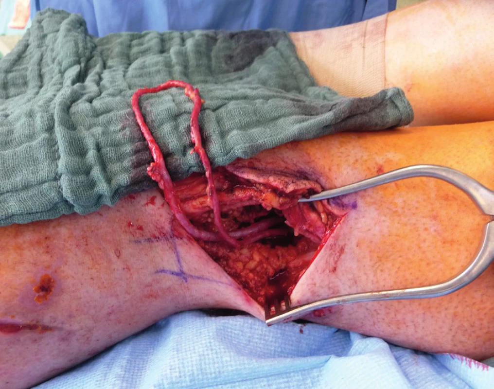 The pedicle of ALT flap and stent placement in popliteal
artery justify the use of Corlett loop (temporary AV–shunt)