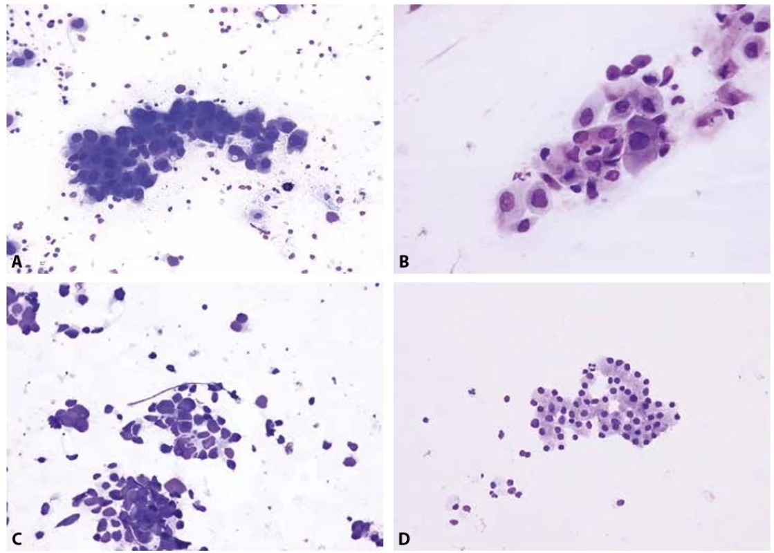 Základní diagnostické jednotky maligních epitelových nádorů plic.<br>
A – metastatický adenokarcinom s excentricky umístěnými jádry a místy patrnou vakuolizací cytoplazmy (EBUS-FNA mediastinální lymfatické uzliny; Diff-
-Quik®, 400x)<br> B – otisk excize endobronchiálně rostoucího dlaždicobuněčného karcinomu s denzní plachtovitou cytoplazmou a nepravidelnými jádry s hrubým
chromatinem (Diff-Quik®, 400x)<br> C - metastáza malobuněčného karcinomu, charakteristického skupinkami menších buněk s úzkým cytoplazmatickým lemem
a arteficiální deformací jader (perkutánní tenkojehlová aspirace subklavikulární lymfatické uzliny; Diff-Quik®, 400x)<br> D – karcinoid bronchu - poměrně uniformní
buňky s bazofilní jemně granulární cytoplazmou, tvořící trabekuly (rozlišení mezi typickým a atypickým karcinoidem není z cytologického vyšetření možné)
(nátěr z endobronchiálního aspirátu; Giemsa, 200x)