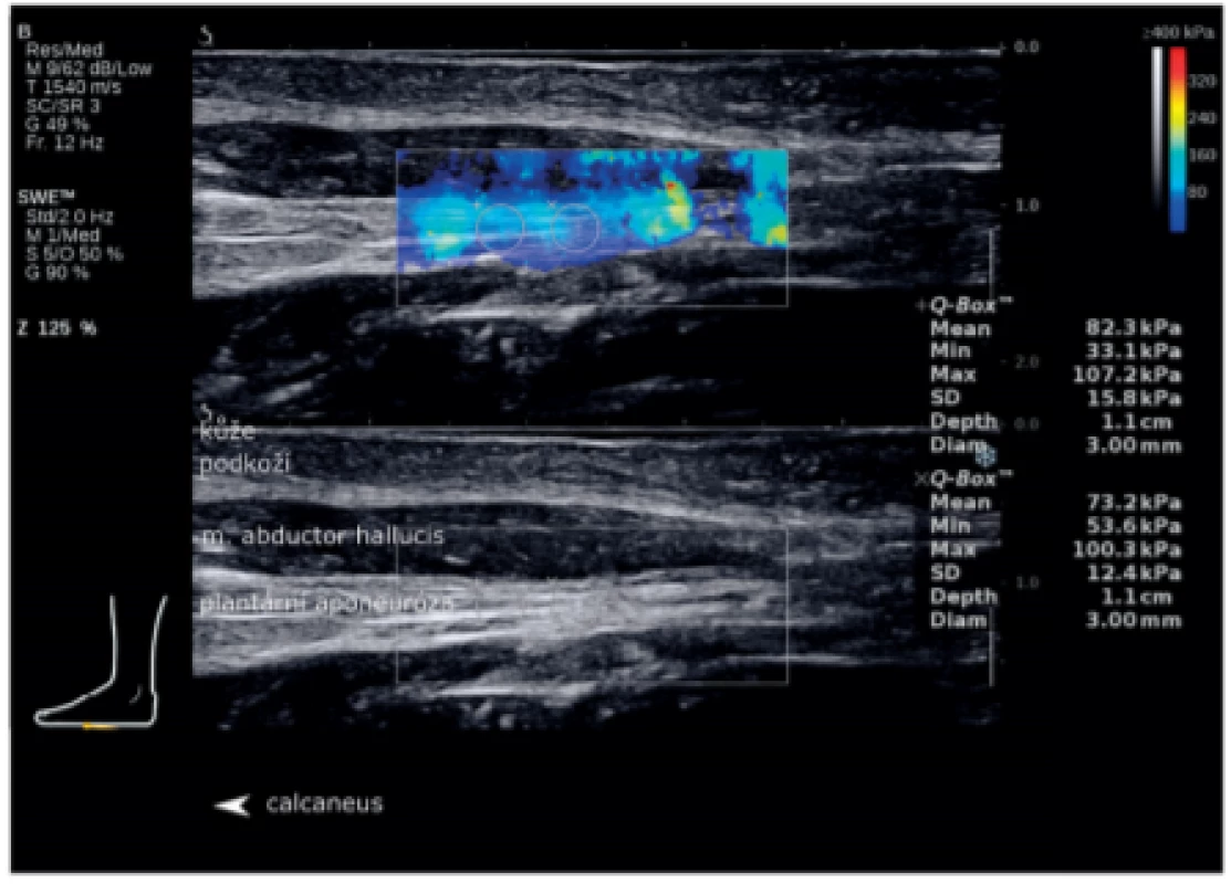 Shear wave elastografie (SWE)