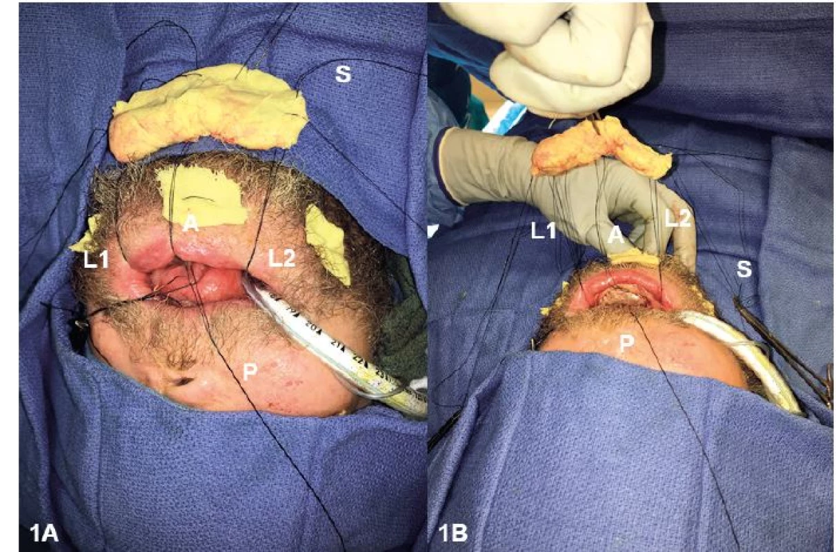 (A, B) Application of the intraoral bolster. The bolster was secured using 2-0 silk-tie-over sutures at the anterior (A), posterior (P),
and lateral (L1, L2) poles. A safety suture (S) was passed through the bolster