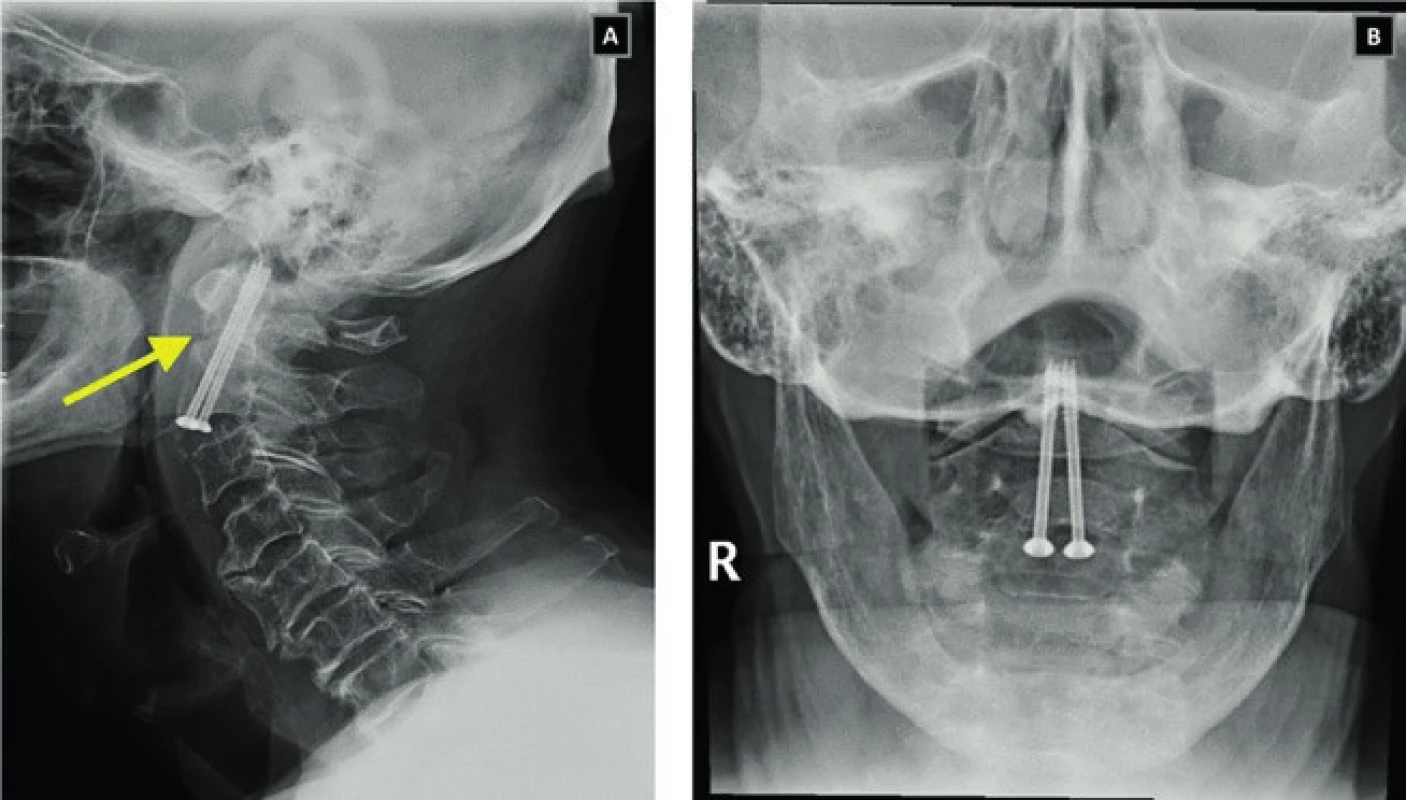 RTG snímky krční páteře v bočné (A) a transorální projekci u pacienta po přímé kompresní osteosyntéze dentu. Šipka ukazuje na místo zlomeniny