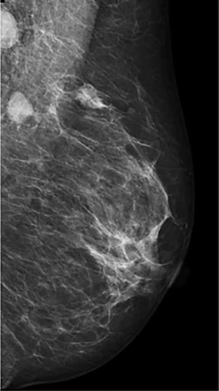 Karcinom prsu s postiženými lymf. uzlinami v axile před NT <br>Fig. 1: Breast carcinoma with axillary lymph node metastases before NT

