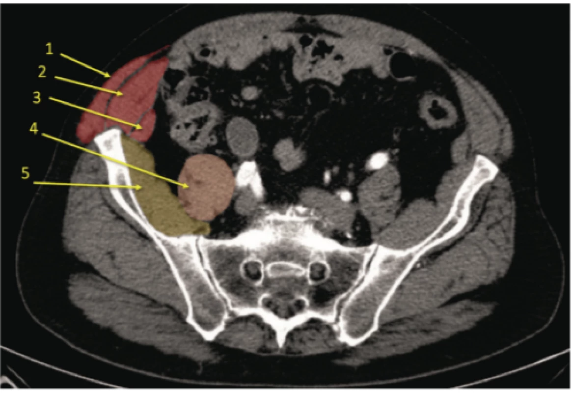 CT řez v  úrovni S2: 1. m. obliquus abdominis externus,
2. m. obliquus abdominis internus, 3. m. transversus abdominis, 4. m. psoas
major, 5. m. iliacus