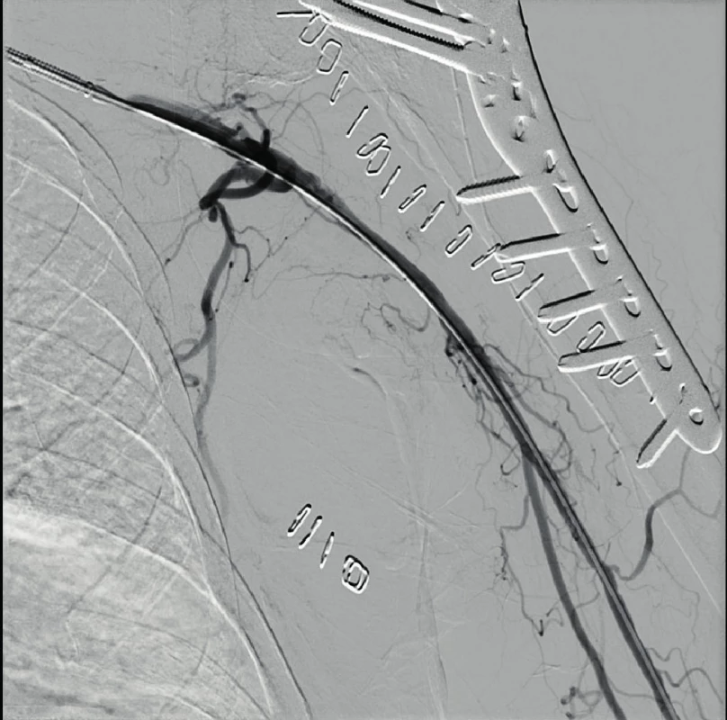 PTA of axillary artery closure with recanalization via common
femoral artery