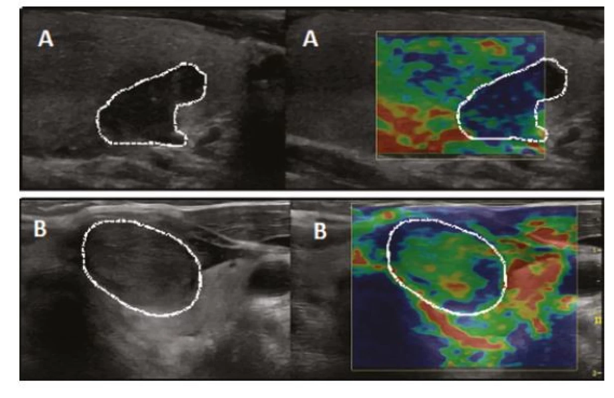 Elastografický obraz maligního (A) a benigního (B) tyreoidálního
uzlu