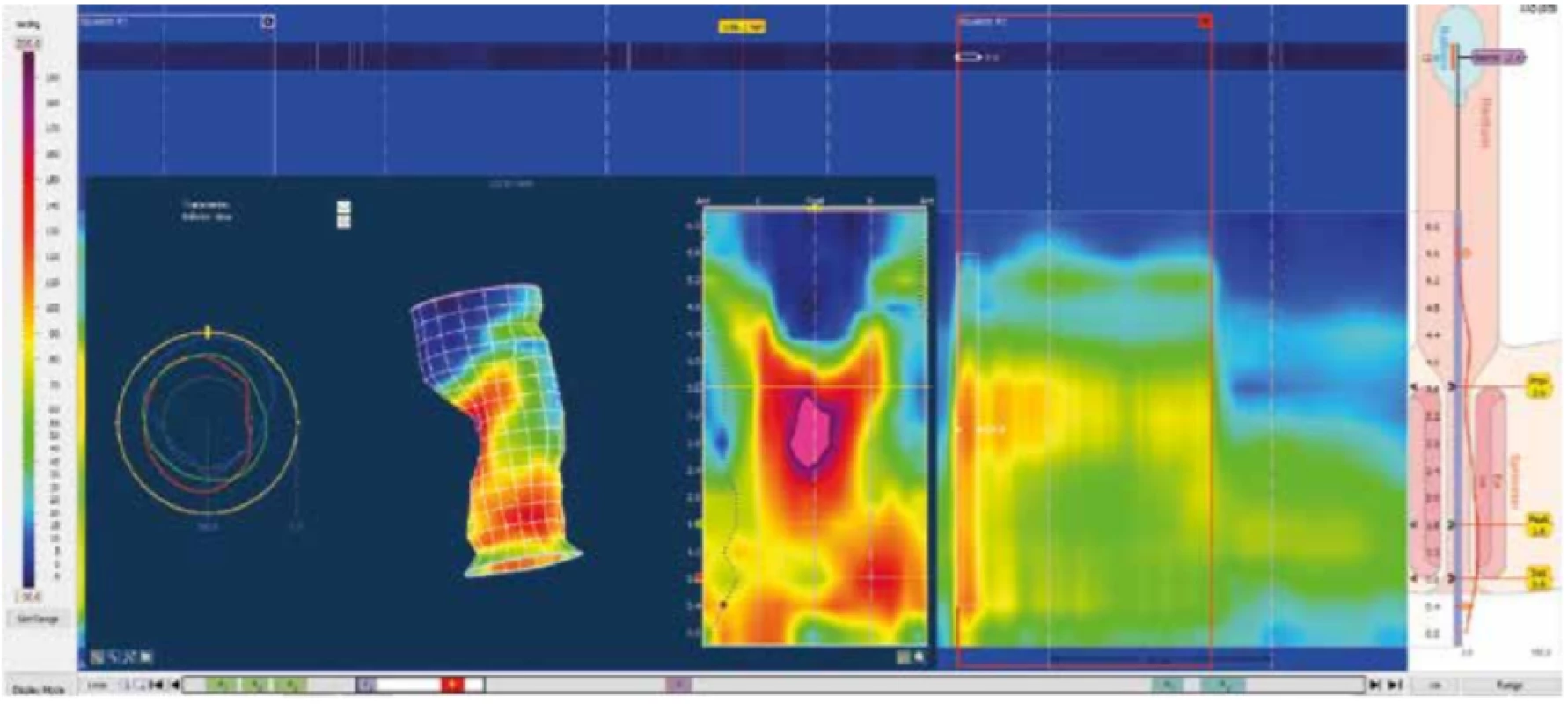 Manévr sevření
Zdroj: Archiv oddělení gastrointestinální endoskopie, Ústřední vojenská nemocnice − Vojenská fakultní nemocnice, Praha<br>
Fig. 7: Squeeze maneuver
Source: Department of Gastrointestinal Endoscopy archive, Military University Hospital, Prague