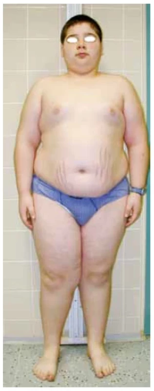 11letý pacient s plně
rozvinutým obrazem Cushingova
syndromu včetně obezity,
purpurových strií, měsícovitého
obličeje, izosexuální pseudopuberty
a poruchy růstu
(foto archiv autorů)