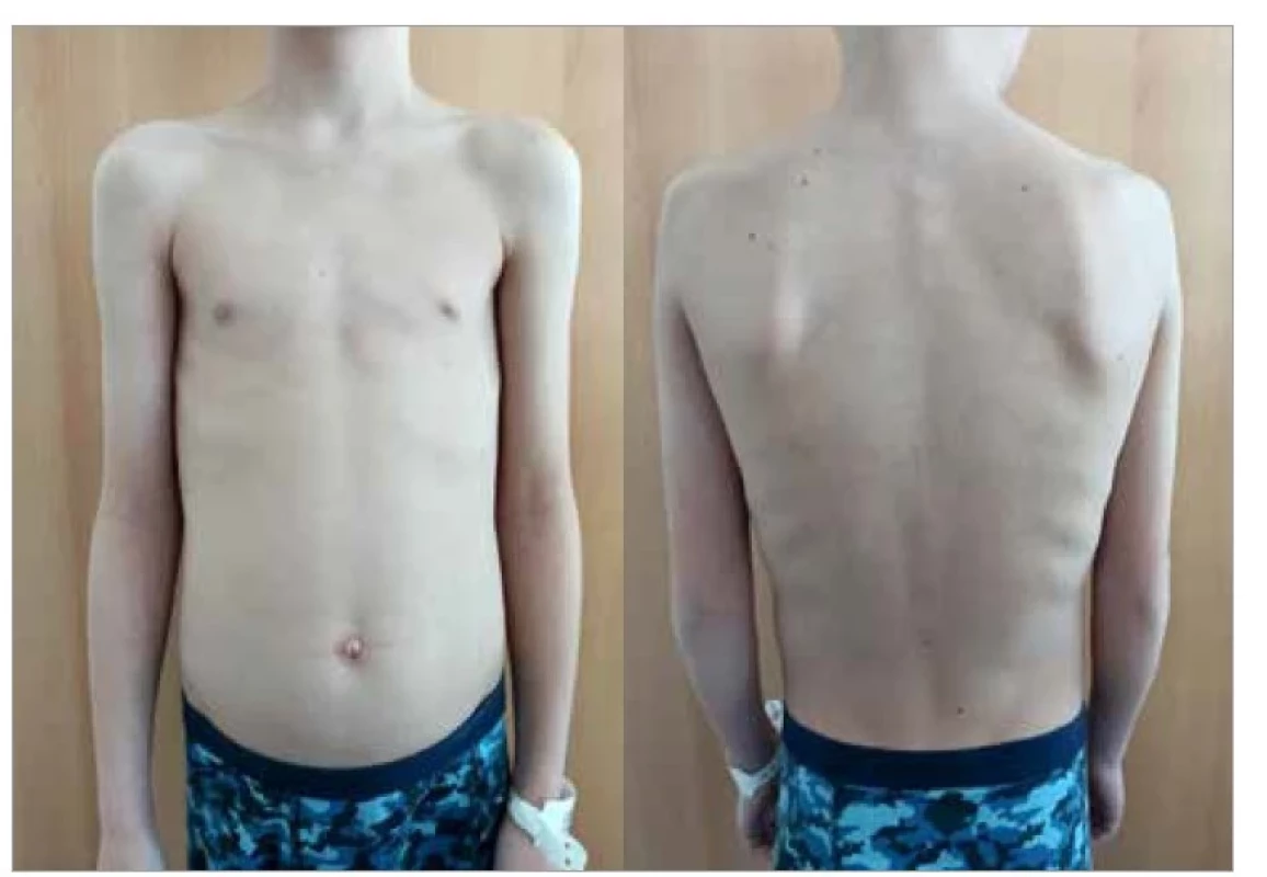 Hrudník a držení těla pacienta s cystickou fibrózou.<br>
Fig. 4. Chest and posture of a patient with cystic fibrosis.