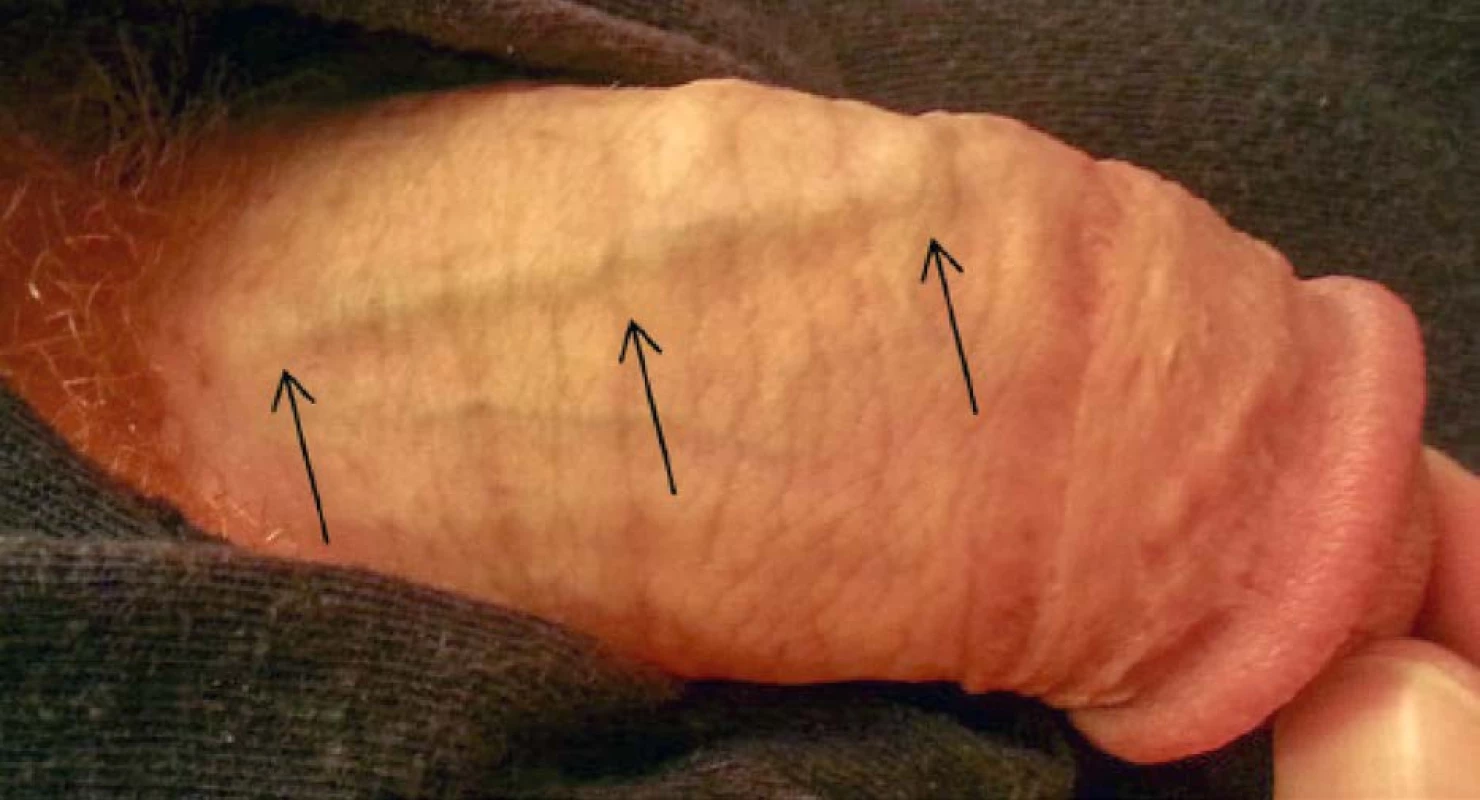 Tuhý pruh v průběhu dorzální žíly – Ilustrativní foto – zdroj (9)<br>
Fig. 1. Palpable rigid stripe affecting the dorsal vein