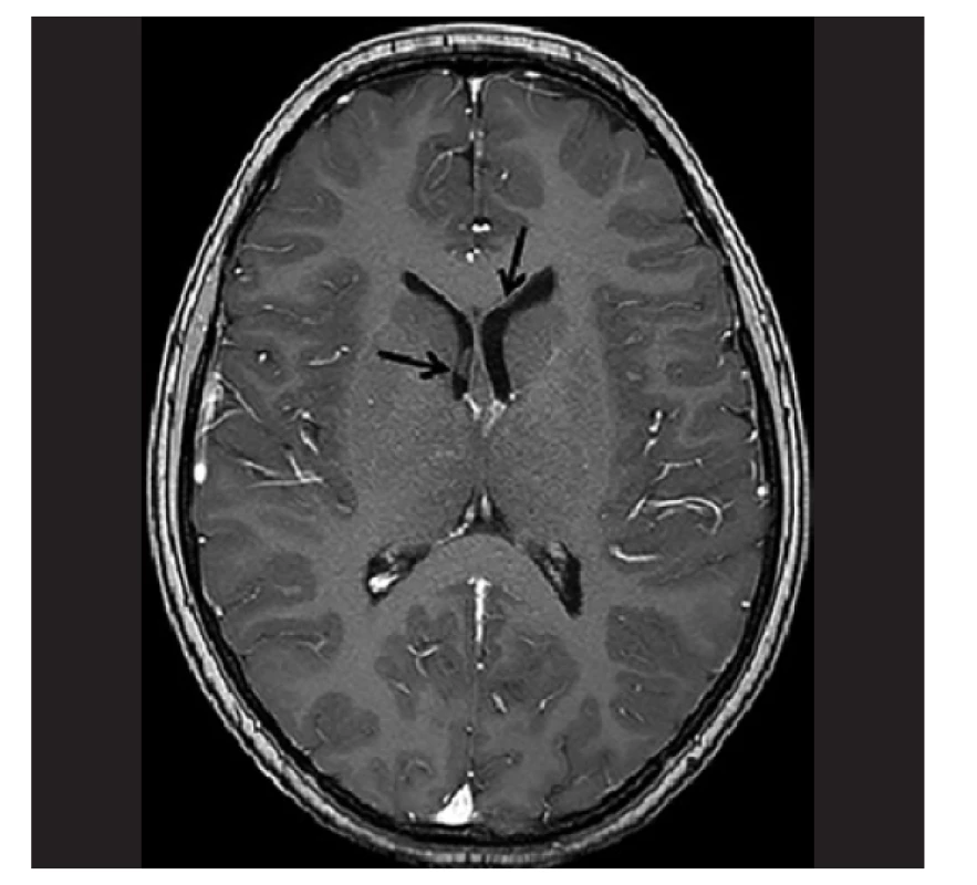 MRI pacientky s LGG s prokázaným fúzním genem BCR1-NTRK3. Na
MRI mozku se zaměřením na zrakovou dráhu byl nález solidní patologické
expanze v oblasti optického chiasmatu s propagací suprachiasmaticky, ventrálně
do oblasti baze frontálního laloku vlevo a dorzálně do oblasti mediální
části temporálního laloku a insuly vpravo.