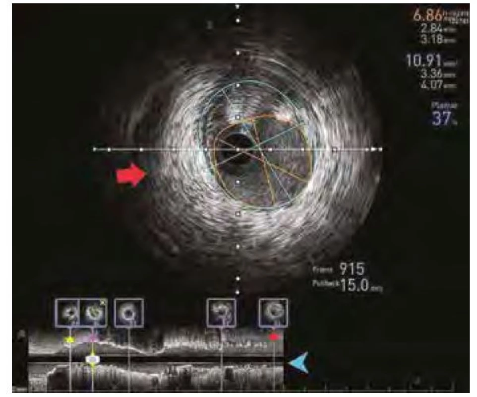 IVUS záznam umožňující analýzu rozsahu koronárního postižení,
referenčního diametru tepny a délky postiženého úseku. Červená šipka značí
příčný řez koronární tepnou, modrá šipka značí záznam z řezu podélného.
Červenou hvězdou je pak označen nejdistálnější bod, fialovou místo zájmu
zobrazené i na příčném řezu a žlutou oblast proximální