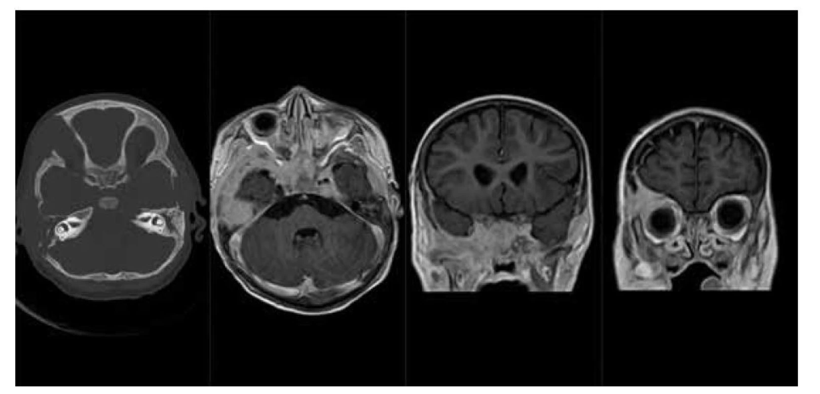 LCH baze lební: a) nativní CT scan v kostním okně, osteolytické léze pravé frontální kosti, zevní porce
pravé temporální kosti a sfenoidální kosti vlevo, b) MR scan – T1 sekvence po podání kontrastní látky v axiální
rovině, solidní měkkotkáňové sytící se expanze baze lební v rozsahu sfenoidálních a temporálních kostí
oboustranně, c, d) MR scan – T1 sekvence po podání k. l. v koronární rovině, sytící se expanze baze lební
a stropu pravé orbity.<br>
Fig. 4. LCH of skull base: a) CT scan – bone window, lytic lesions of frontal bone, temporal bone on the right
side and sphenoid bone on the left, b) MR scan – T1 after contrast medium injection, axial plane, soft tissue
tumors of skull base, c, d) MR scan – T1 after contrast medium injection, coronal plane, enhansing tumor of
skull base and the right orbit ceiling.