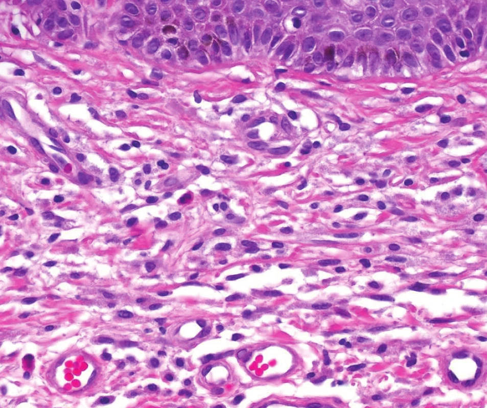 Histologický obraz Urticaria pigmentosa
