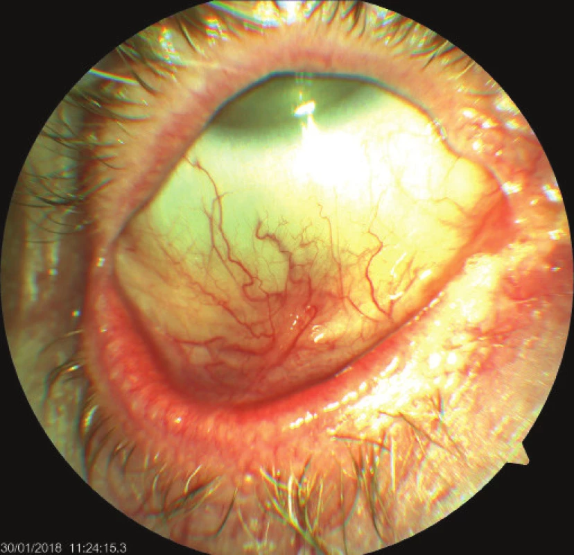 Right eye of patient – cicatrising blepharoconjunctivitis,
whitish plaques on edges of eyelids, symblepharon
later appearing